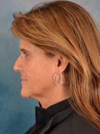 Rhinoplasty Before & After Gallery - Patient 165317 - Image 1