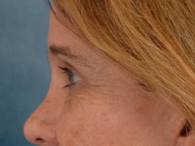 Eyelid Lift Before & After Gallery - Patient 635760 - Image 10