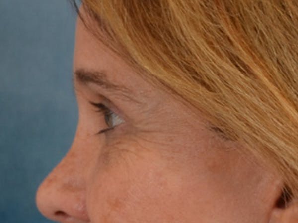 Eyelid Lift Before & After Gallery - Patient 635760 - Image 10