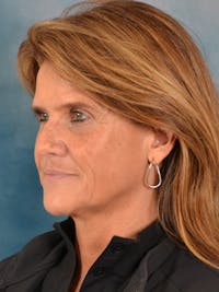 Deep Plane Facelift Before & After Gallery - Patient 977677 - Image 1