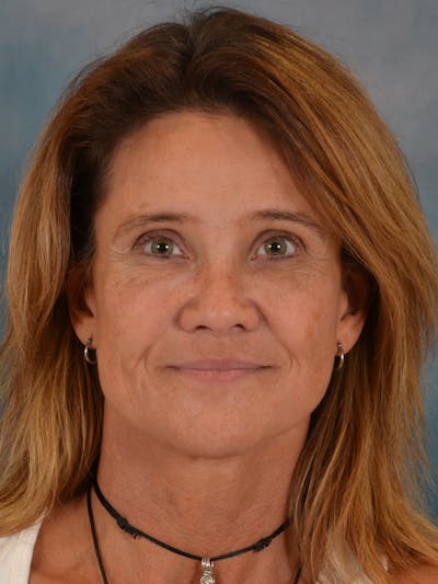 Laser Skin Resurfacing Before & After Gallery - Patient 151667 - Image 2