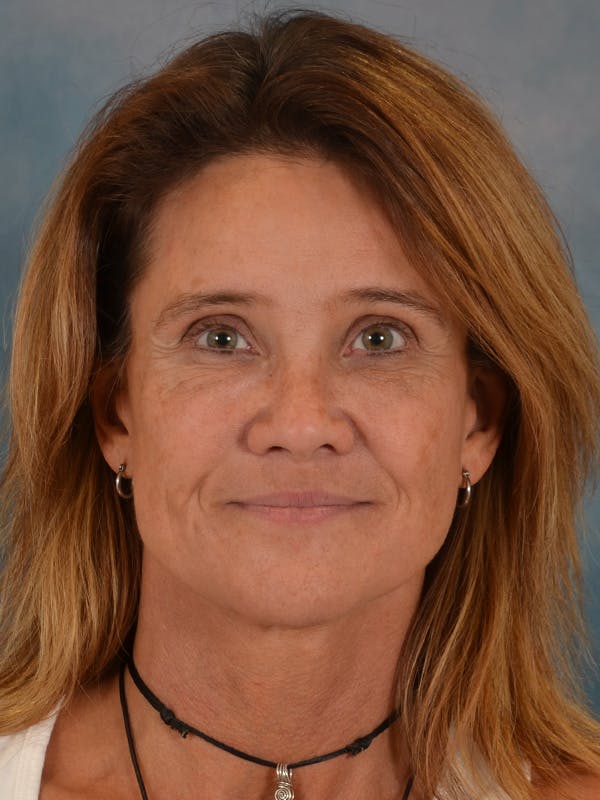 Laser Skin Resurfacing Before & After Gallery - Patient 151667 - Image 2