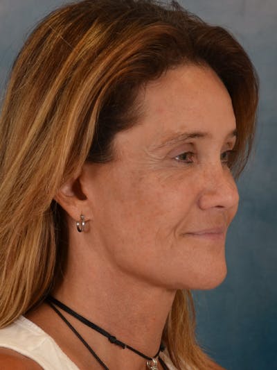 Laser Skin Resurfacing Before & After Gallery - Patient 151667 - Image 4