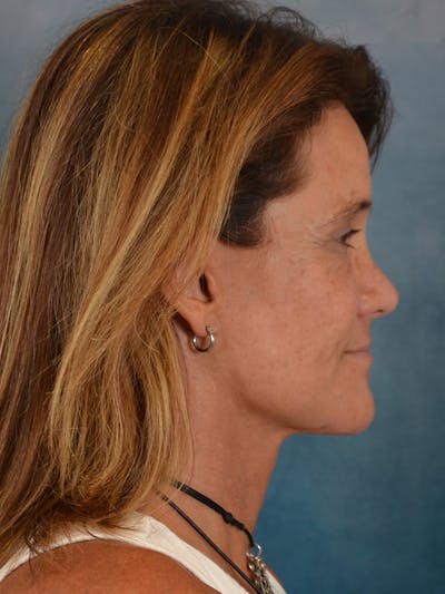 Laser Skin Resurfacing Before & After Gallery - Patient 151667 - Image 6