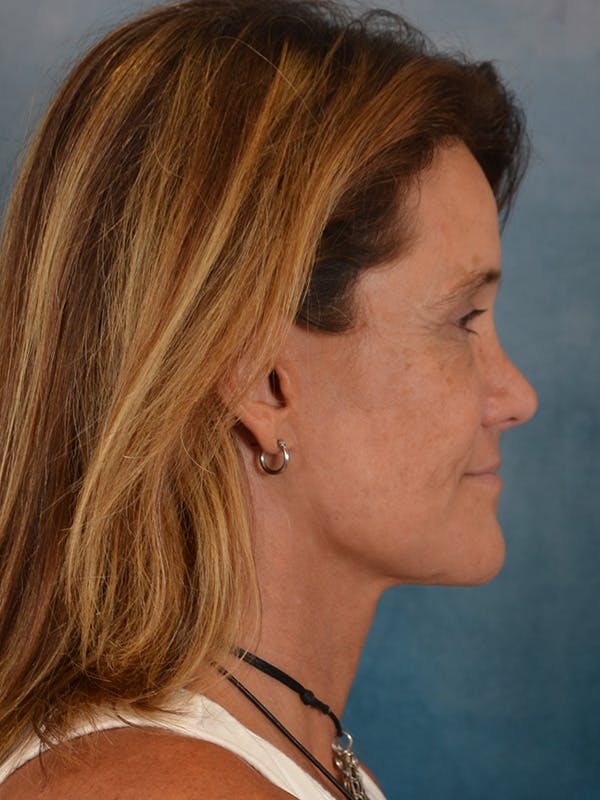 Laser Skin Resurfacing Before & After Gallery - Patient 151667 - Image 6