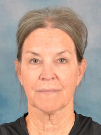 Laser Skin Resurfacing Before & After Gallery - Patient 247662 - Image 1