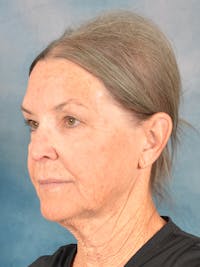 Deep Plane Facelift Before & After Gallery - Patient 213271 - Image 1