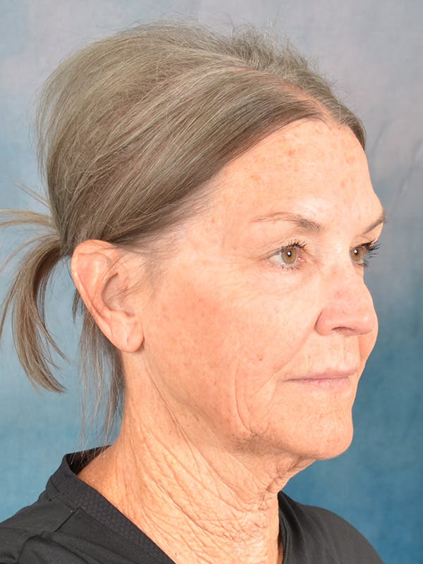 Deep Plane Facelift Before & After Gallery - Patient 213271 - Image 7