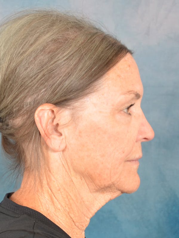 Deep Plane Facelift Before & After Gallery - Patient 213271 - Image 9