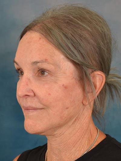 Deep Plane Facelift Before & After Gallery - Patient 213271 - Image 2