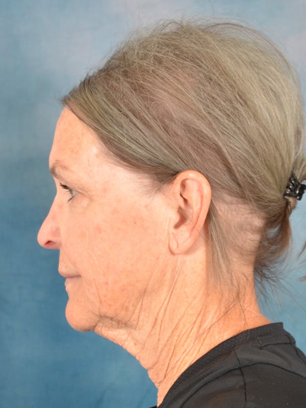 Deep Plane Facelift Before & After Gallery - Patient 213271 - Image 5