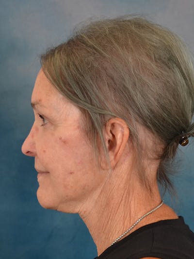 Deep Plane Facelift Before & After Gallery - Patient 213271 - Image 6