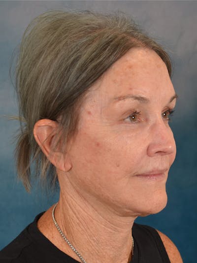 Deep Plane Facelift Before & After Gallery - Patient 213271 - Image 8