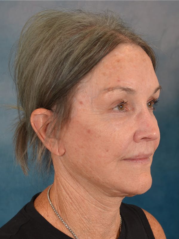 Deep Plane Facelift Before & After Gallery - Patient 213271 - Image 8