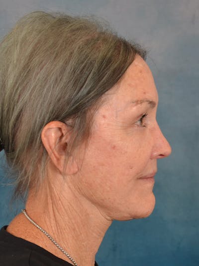 Deep Plane Facelift Before & After Gallery - Patient 213271 - Image 10