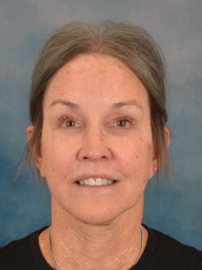 Laser Skin Resurfacing Before & After Gallery - Patient 247662 - Image 2