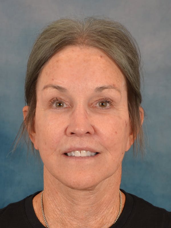 Deep Plane Facelift Before & After Gallery - Patient 213271 - Image 4