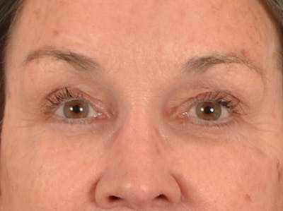 Brow Lift Before & After Gallery - Patient 143554 - Image 2