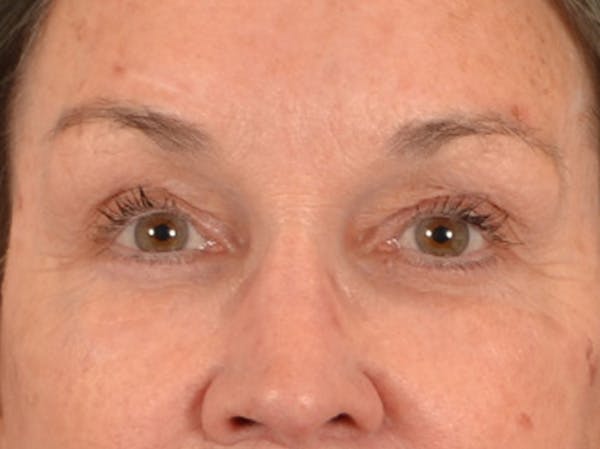 Brow Lift Before & After Gallery - Patient 143554 - Image 2