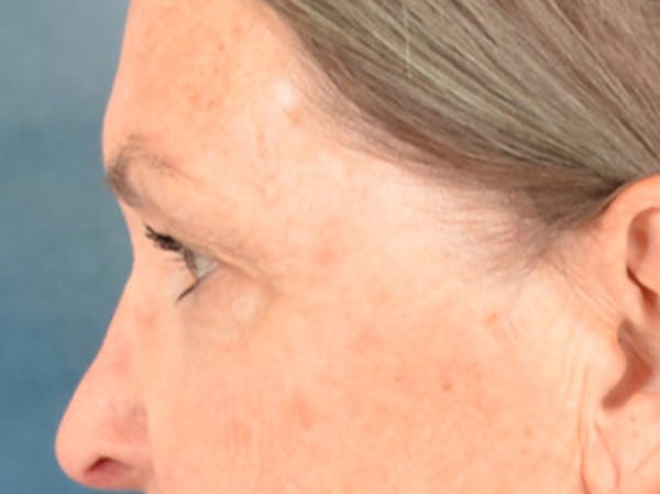 Brow Lift Before & After Gallery - Patient 143554 - Image 9