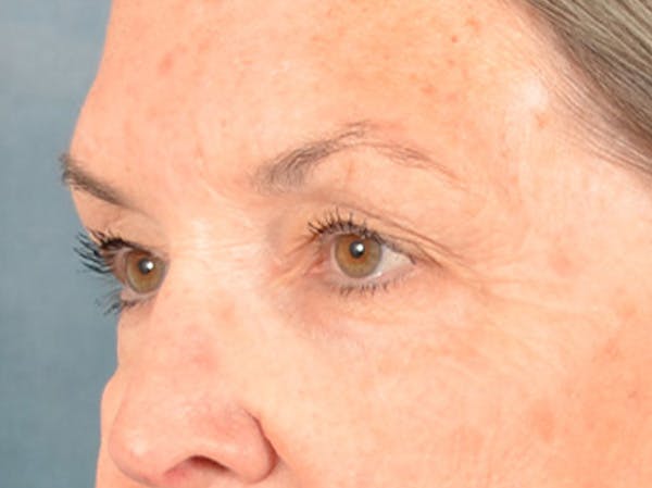 Brow Lift Before & After Gallery - Patient 143554 - Image 7