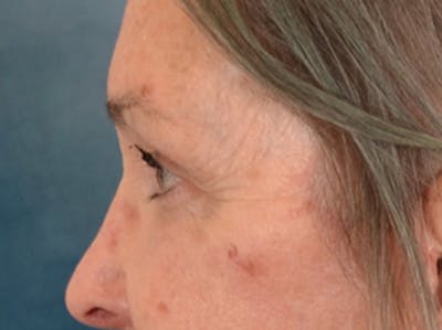 Brow Lift Before & After Gallery - Patient 143554 - Image 10