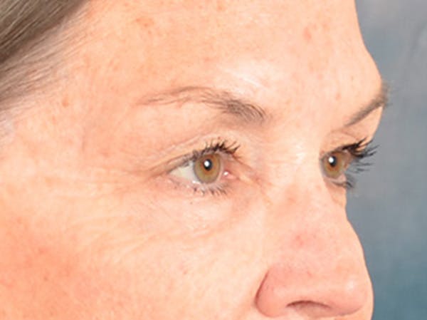 Brow Lift Before & After Gallery - Patient 143554 - Image 3