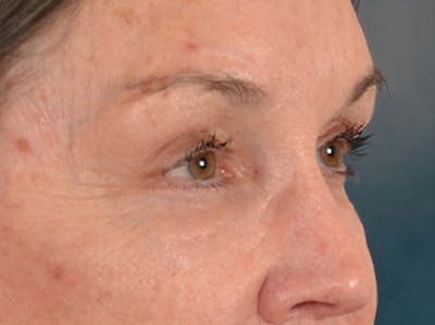 Brow Lift Before & After Gallery - Patient 143554 - Image 4