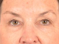 Brow Lift Before & After Gallery - Patient 143554 - Image 1