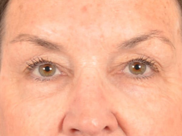 Brow Lift Before & After Gallery - Patient 143554 - Image 1