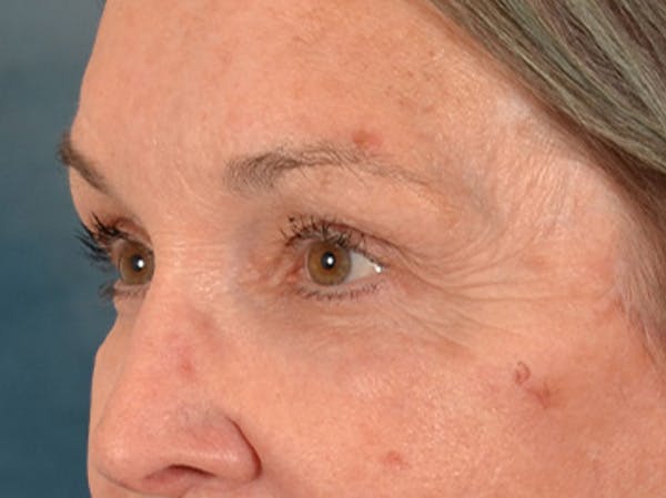 Brow Lift Before & After Gallery - Patient 143554 - Image 8