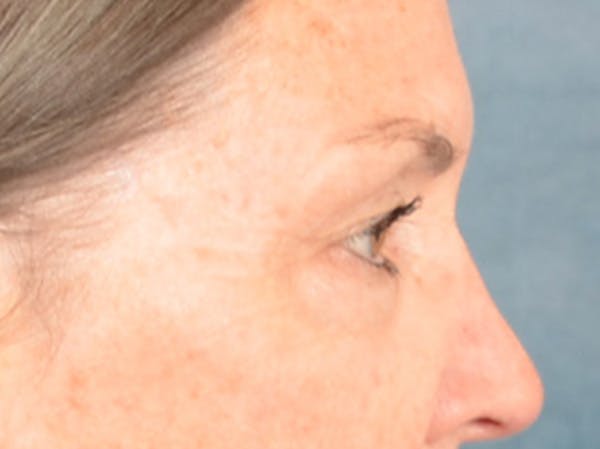Brow Lift Before & After Gallery - Patient 143554 - Image 5