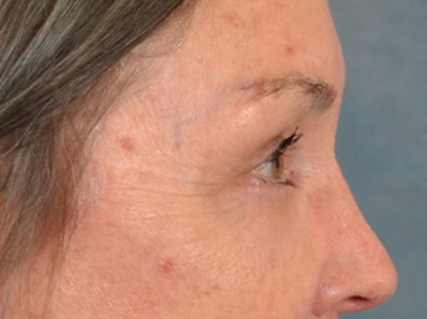 Brow Lift Before & After Gallery - Patient 143554 - Image 6