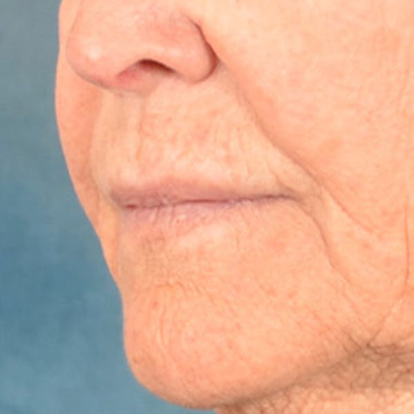 Lip Lift Before & After Gallery - Patient 199502 - Image 7