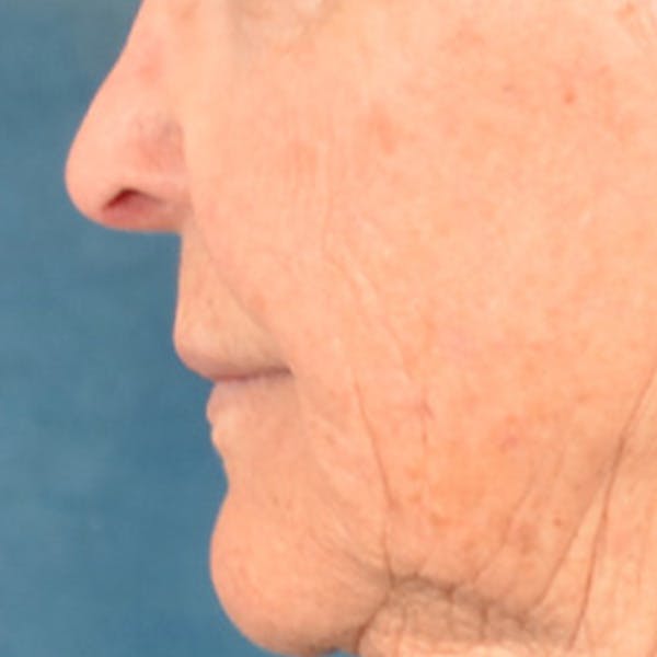 Lip Lift Before & After Gallery - Patient 199502 - Image 9