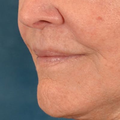 Lip Lift Before & After Gallery - Patient 199502 - Image 8