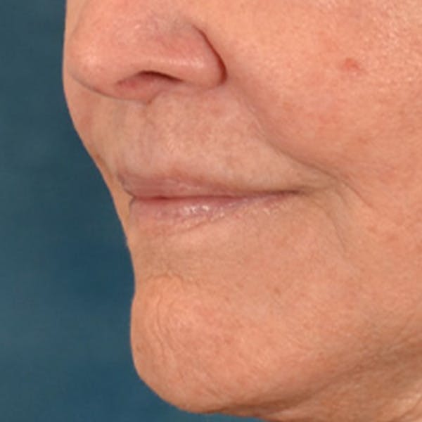 Lip Lift Before & After Gallery - Patient 199502 - Image 8