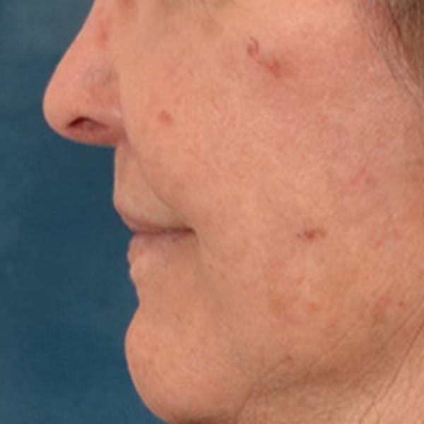 Lip Lift Before & After Gallery - Patient 199502 - Image 10