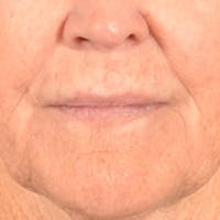 Lip Lift Before & After Gallery - Patient 199502 - Image 1