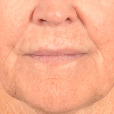 Lip Lift Before & After Gallery - Patient 199502 - Image 1