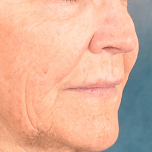 Lip Lift Before & After Gallery - Patient 199502 - Image 3