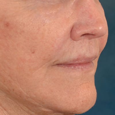 Lip Lift Before & After Gallery - Patient 199502 - Image 4