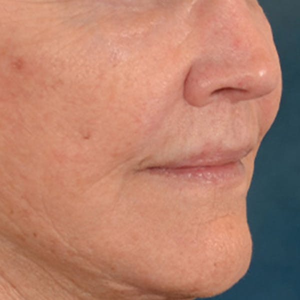 Lip Lift Before & After Gallery - Patient 199502 - Image 4