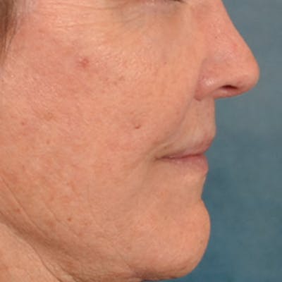 Lip Lift Before & After Gallery - Patient 199502 - Image 6