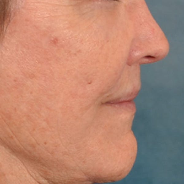 Lip Lift Before & After Gallery - Patient 199502 - Image 6