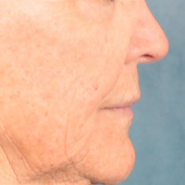 Lip Lift Before & After Gallery - Patient 199502 - Image 5
