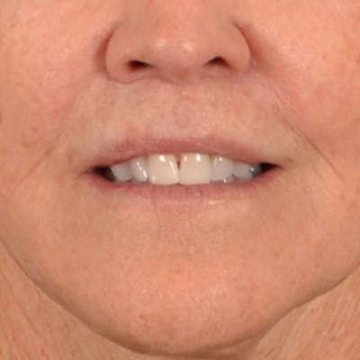 Lip Lift Before & After Gallery - Patient 199502 - Image 2