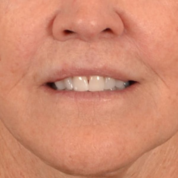Lip Lift Before & After Gallery - Patient 199502 - Image 2