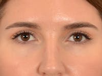 Eyelid Lift Before & After Gallery - Patient 458909 - Image 1