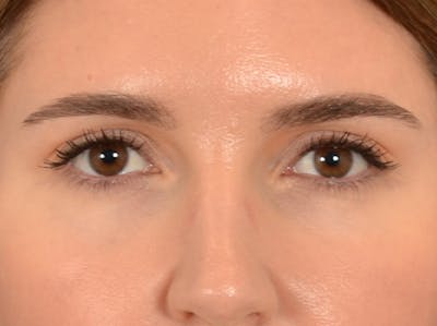 Eyelid Lift Before & After Gallery - Patient 458909 - Image 1